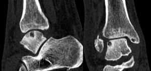 Voorbeeld van een osteochondraal defect, door een scheur in het kraabeen komt er vocht in het bot van het sprongbeen waardoor een holte ontstaat. (CT-scan)