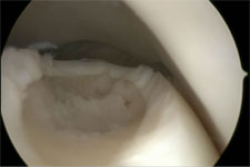 Voorbeeld van een kraakbeendefect in het sprongbeen na "microfracturering"